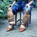 ÉLÉPHANTIASIS